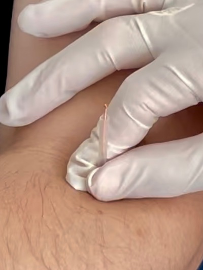 Link to: /pages/acupuncture-physiotherapy